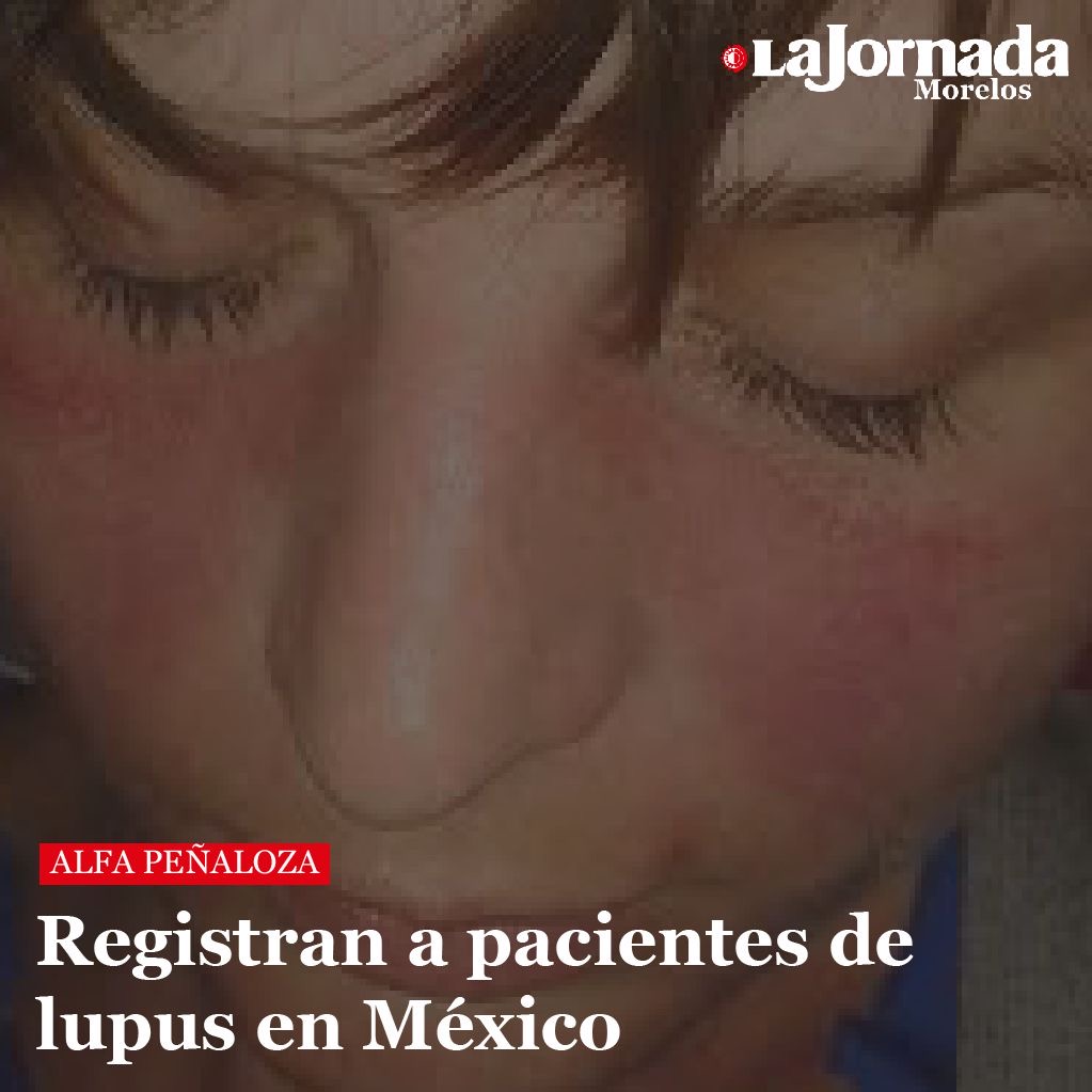 Registran a pacientes de lupus en México