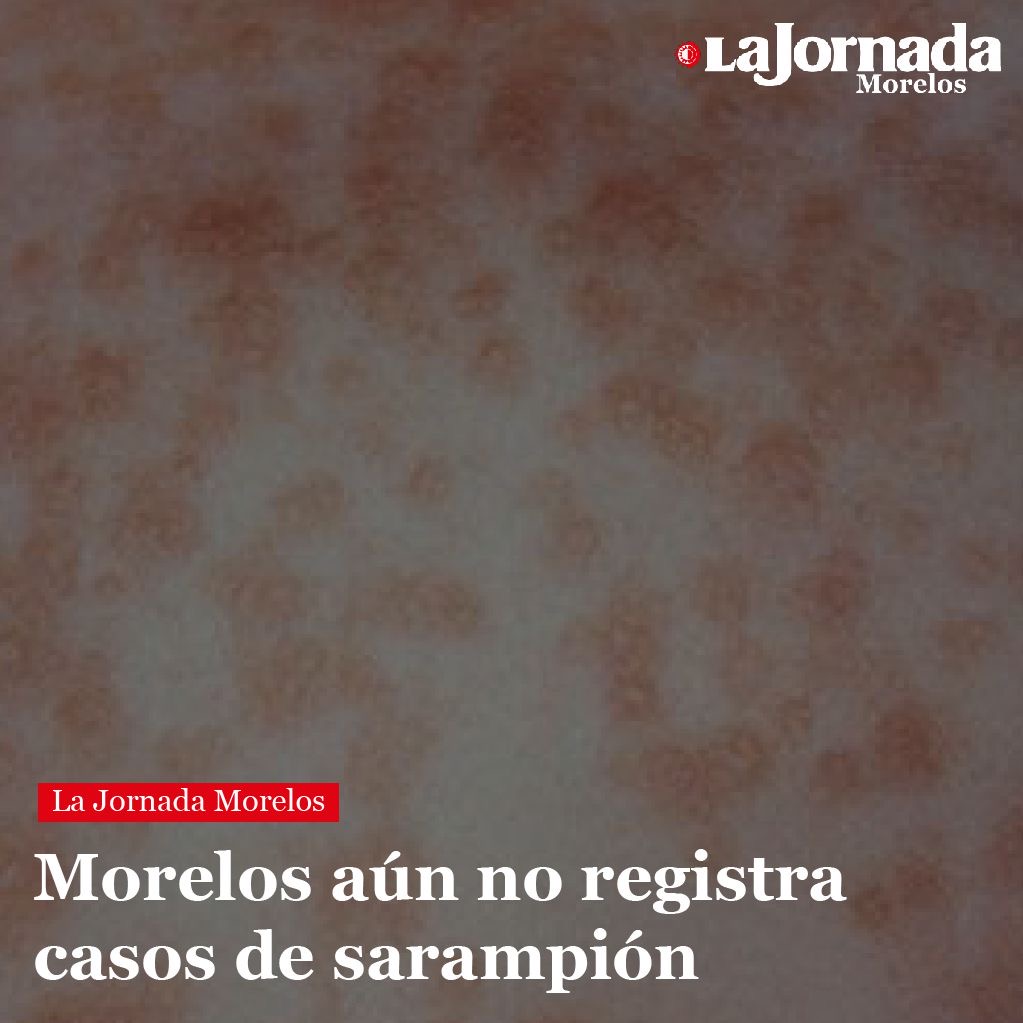 Morelos aún no registra casos de sarampión